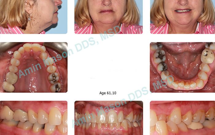 Adjunctive Orthodontic Treatments - Yang Orthodontics
