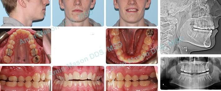 Limited Orthodontic Treatment